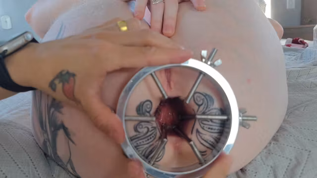 Anal dilation makes my butt folds burst.