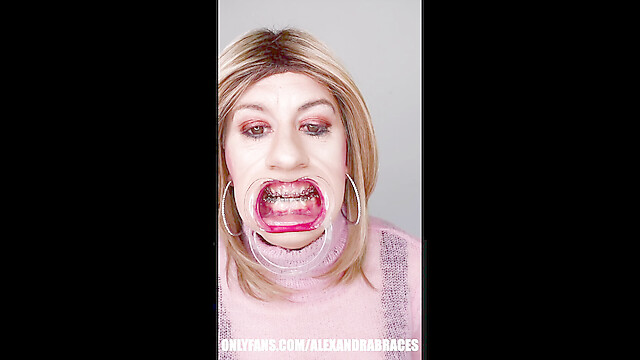 AlexandraBraces